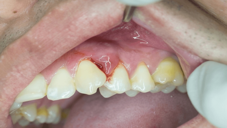 What to Do if a Dental Abscess Bursts on Its Own